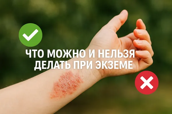 Экзема Экзема